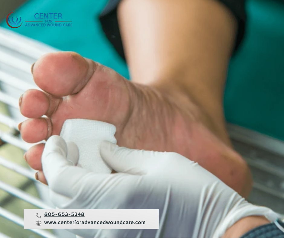 Close-up of a diabetic foot ulcer with medical treatment being applied.